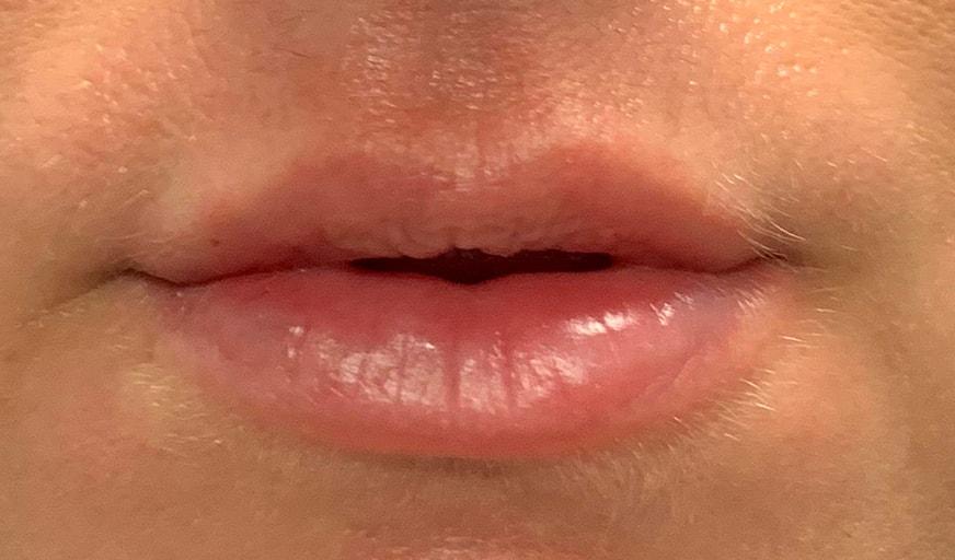 Shari Reitzen, MD lip filler after — New York, NY