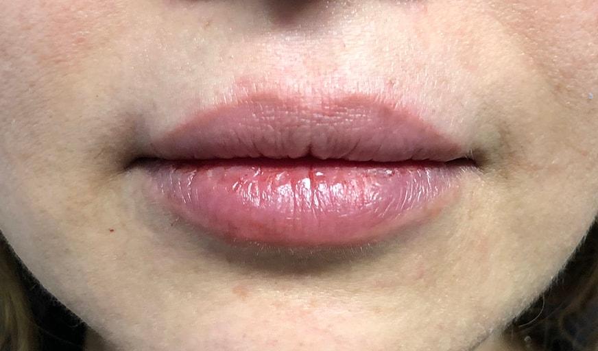 Shari Reitzen, MD lip filler after — New York, NY