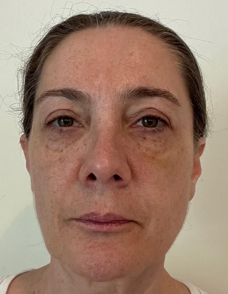 Shari Reitzen, MD under-eye filler after — New York, NY