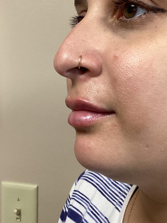 Lip Filler after at Zelko Aesthetics in Greenfield, WI