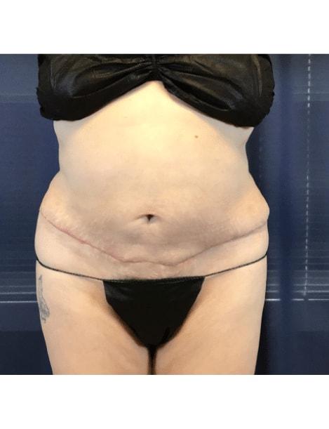 Tummy Tuck after at Zelko Aesthetics in Greenfield, WI