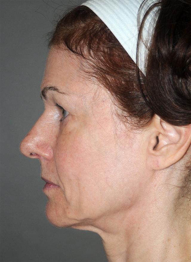 Jawline Filler before at Zelko Aesthetics in Greenfield, WI