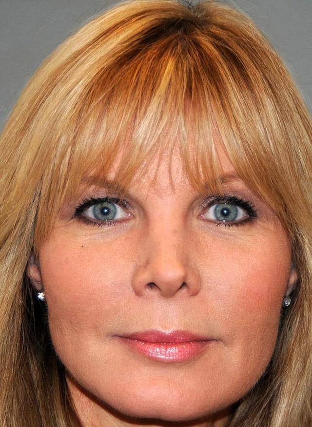 Juvederm after at Zelko Aesthetics in Greenfield, WI