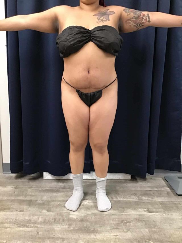 Tummy Tuck after at Zelko Aesthetics in Greenfield, WI