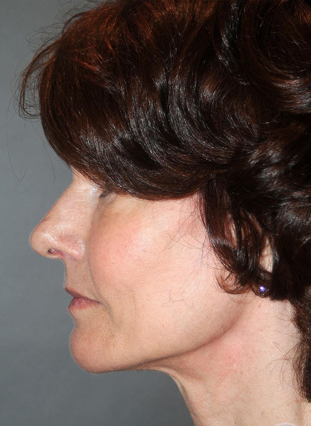 Zelko Aesthetics jawline filler after — Greenfield, WI