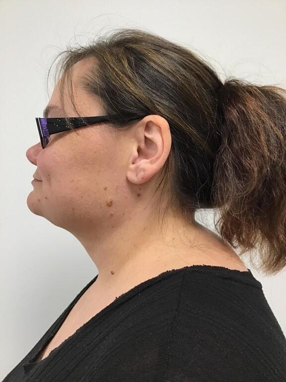 Morpheus8 after at Zelko Aesthetics in Greenfield, WI