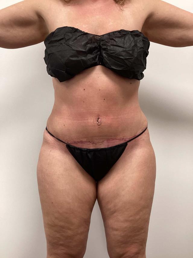 Tummy Tuck after at Zelko Aesthetics in Greenfield, WI