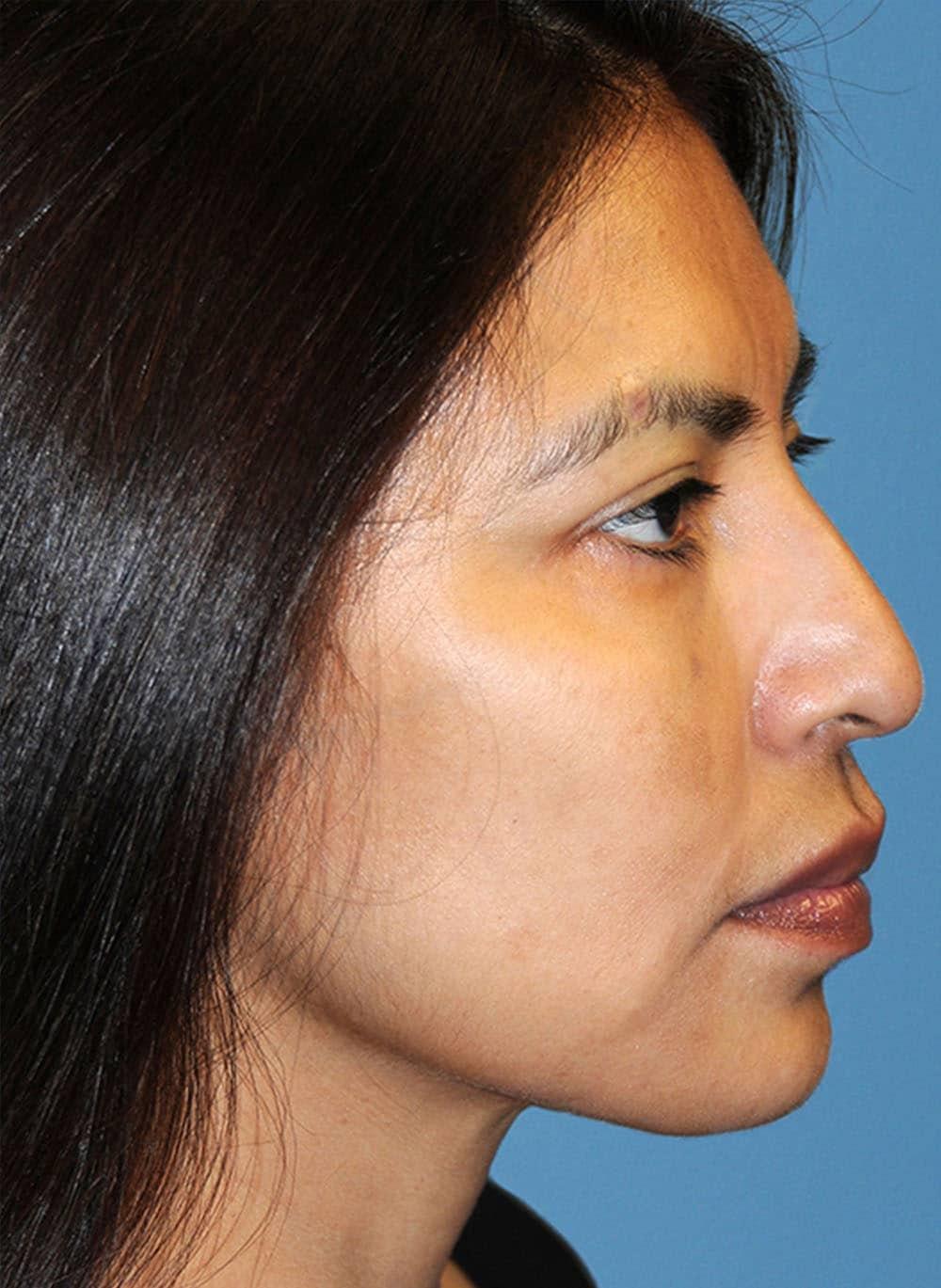 Zelko Aesthetics jawline filler after — Greenfield, WI