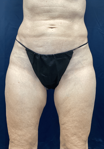 Zelko Aesthetics after — Greenfield, WI
