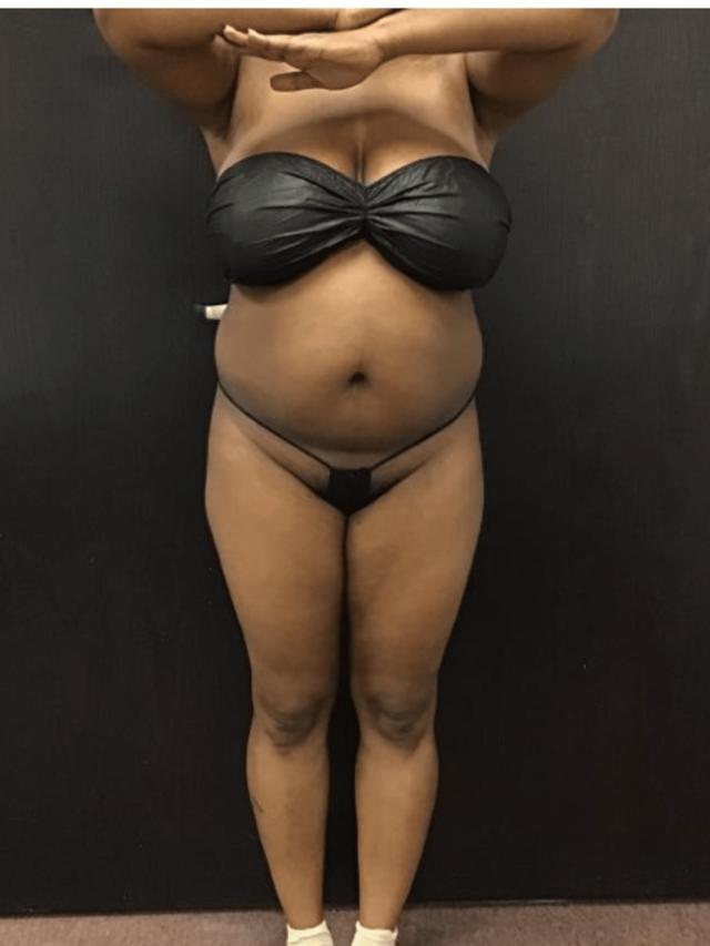 Liposuction before at Zelko Aesthetics in Greenfield, WI