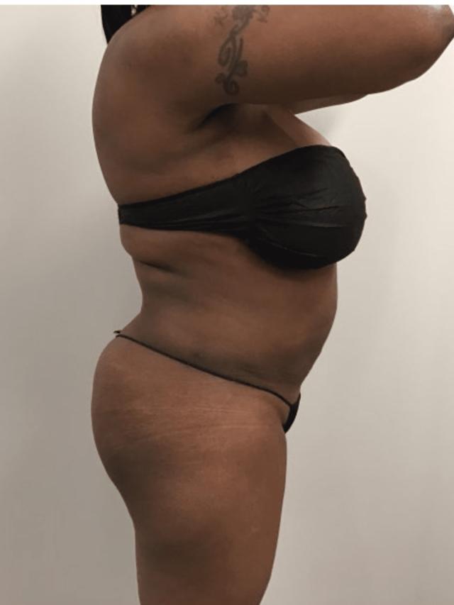 Liposuction after at Zelko Aesthetics in Greenfield, WI