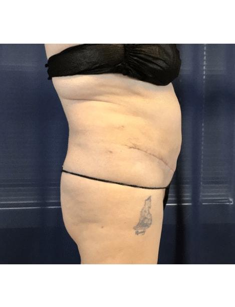 Tummy Tuck after at Zelko Aesthetics in Greenfield, WI