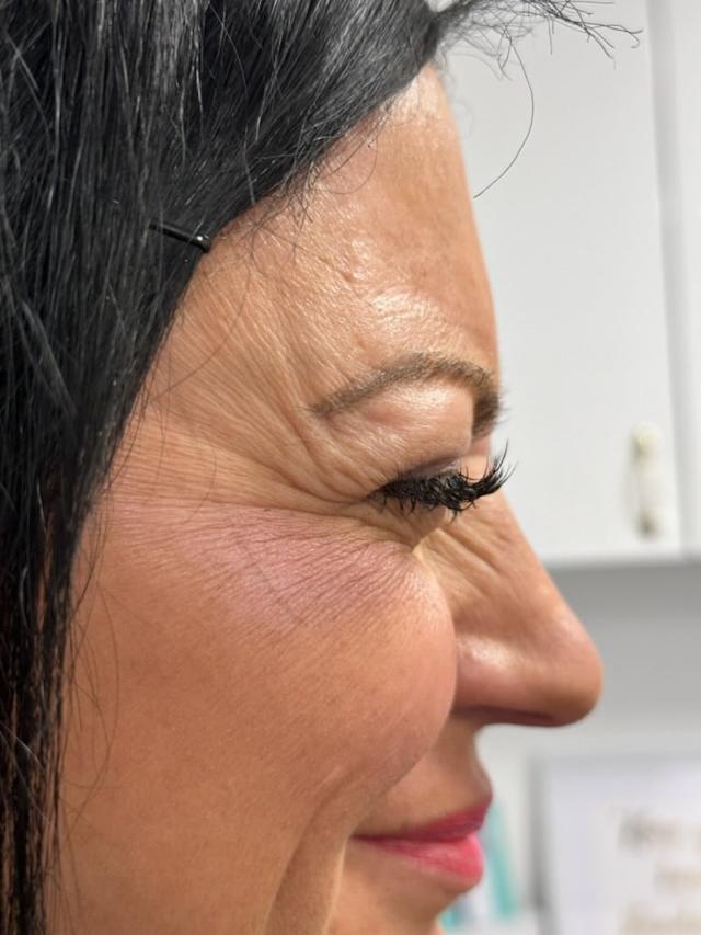 Botox before at Zelko Aesthetics in Greenfield, WI