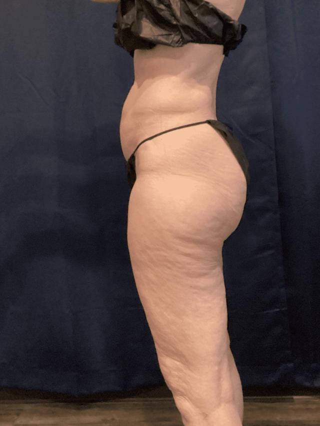 Liposuction before at Zelko Aesthetics in Greenfield, WI