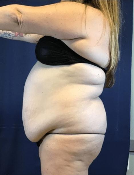 Tummy Tuck before at Zelko Aesthetics in Greenfield, WI