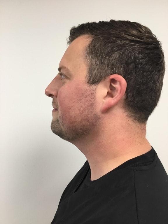 Neck Liposuction after at Zelko Aesthetics in Greenfield, WI