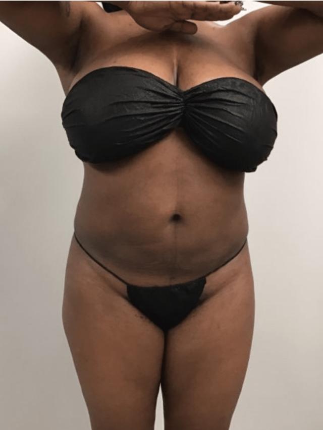 Liposuction after at Zelko Aesthetics in Greenfield, WI