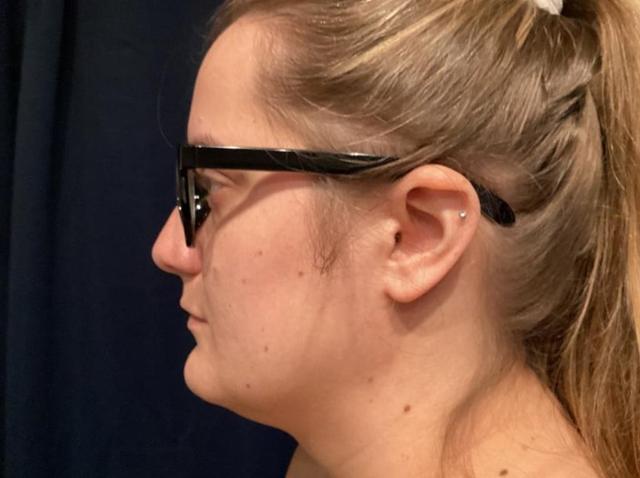 Neck Liposuction before at Zelko Aesthetics in Greenfield, WI