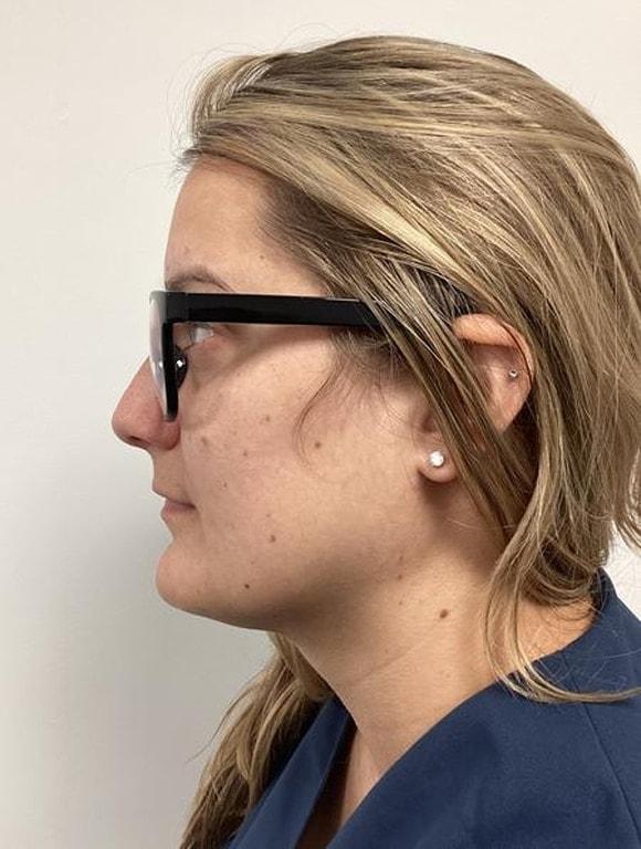 Neck Liposuction after at Zelko Aesthetics in Greenfield, WI
