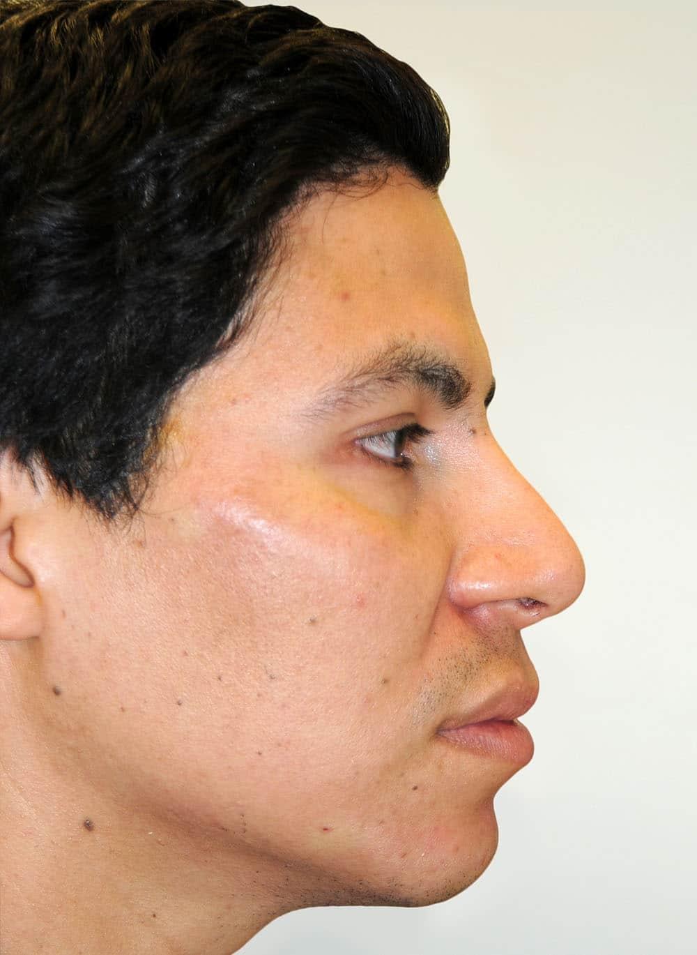Zelko Aesthetics cheek filler after — Greenfield, WI