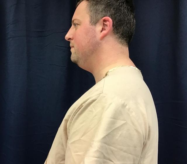 Neck Liposuction before at Zelko Aesthetics in Greenfield, WI