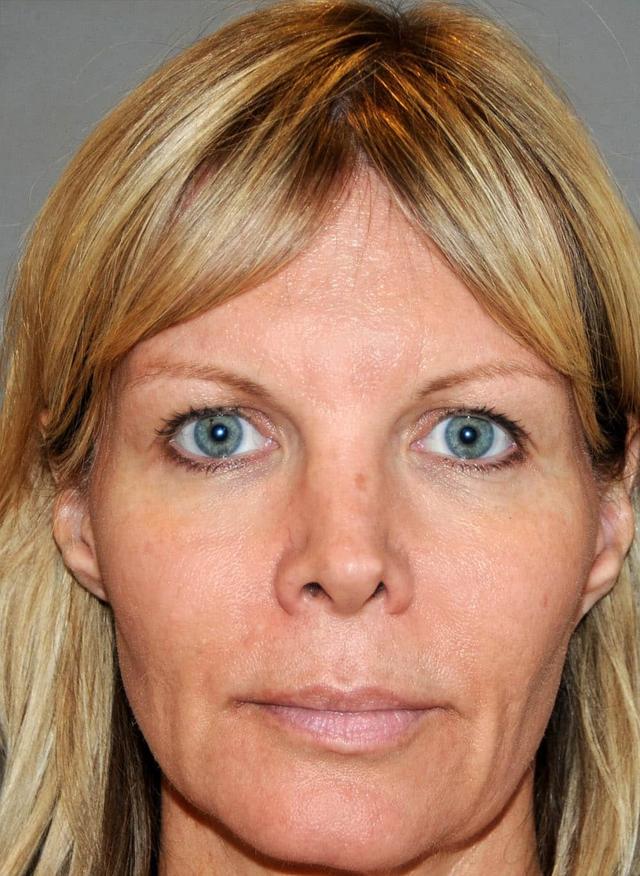 Juvederm before at Zelko Aesthetics in Greenfield, WI
