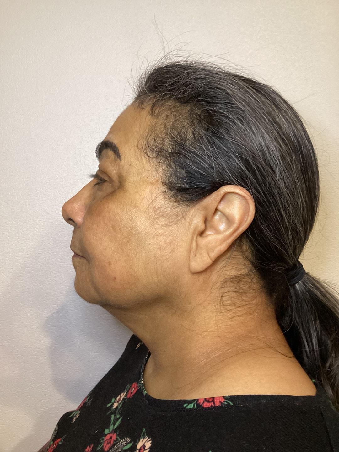 Zelko Aesthetics after — Greenfield, WI