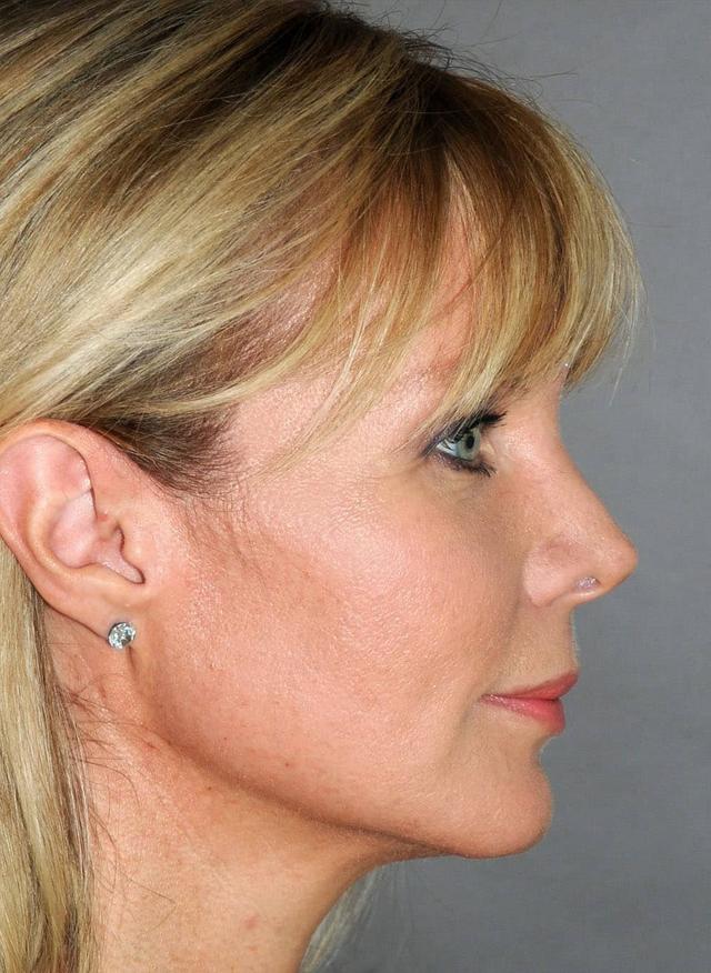 Jawline Filler after at Zelko Aesthetics in Greenfield, WI