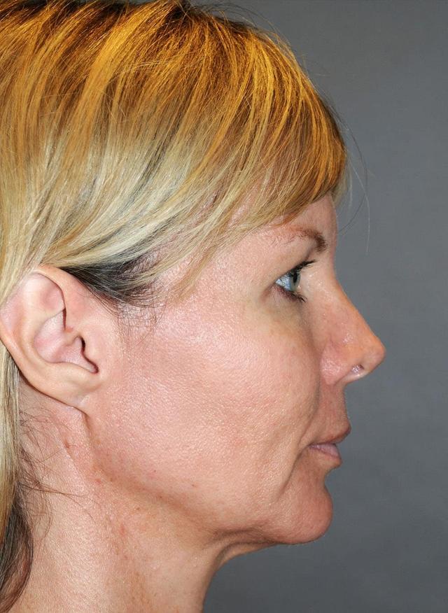 Jawline Filler before at Zelko Aesthetics in Greenfield, WI