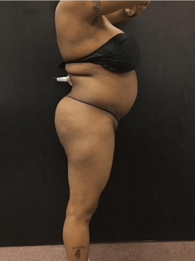 Liposuction before at Zelko Aesthetics in Greenfield, WI