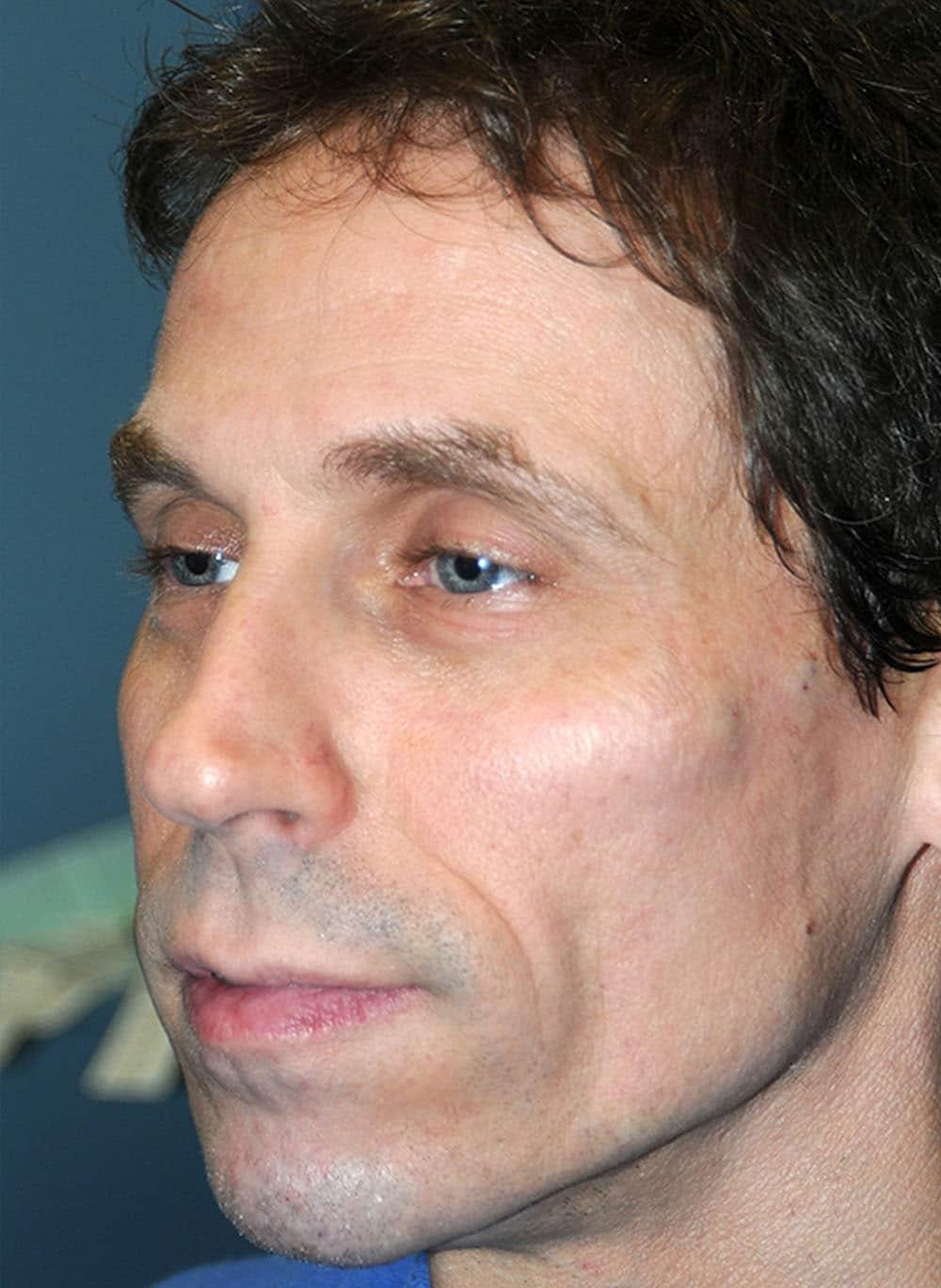 Zelko Aesthetics cheek filler after — Greenfield, WI