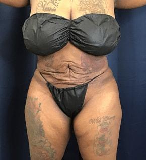 Tummy Tuck before at Zelko Aesthetics in Greenfield, WI