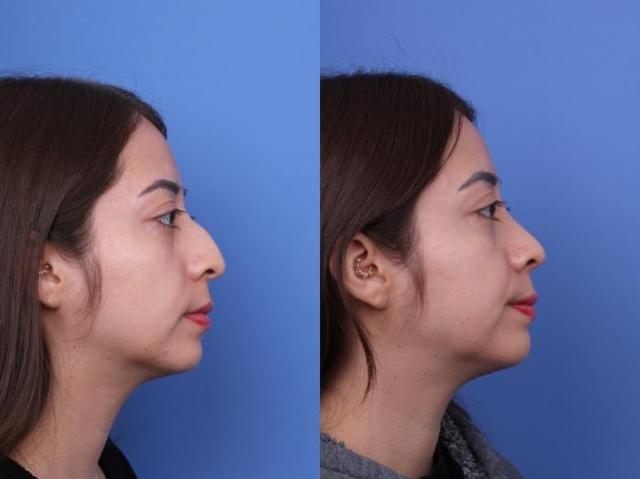 Functional Rhinoplasty result at Todd Hobgood, MD in Scottsdale, AZ