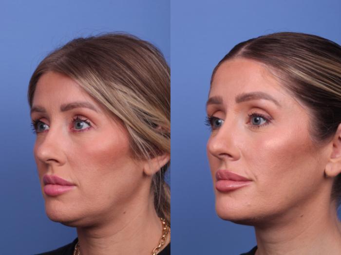 Todd Hobgood, MD liposuction result — Scottsdale, AZ