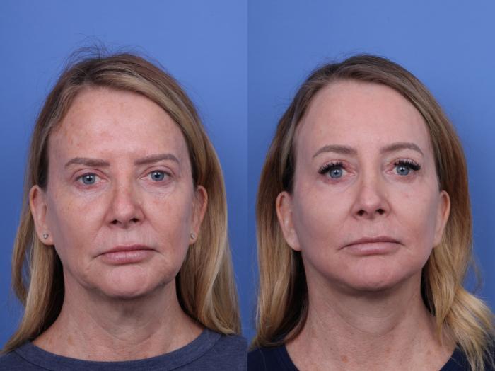 Todd Hobgood, MD brow lift result — Scottsdale, AZ