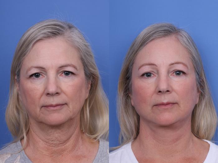 Todd Hobgood, MD brow lift result — Scottsdale, AZ
