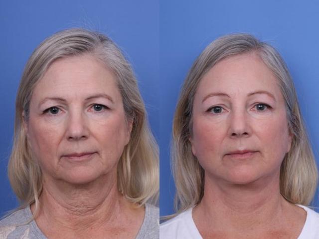 Brow Lift result at Todd Hobgood, MD in Scottsdale, AZ