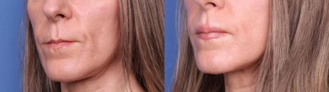 Chin Implant result at Todd Hobgood, MD in Scottsdale, AZ