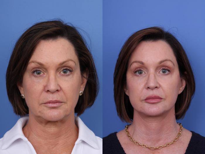 Todd Hobgood, MD brow lift result — Scottsdale, AZ