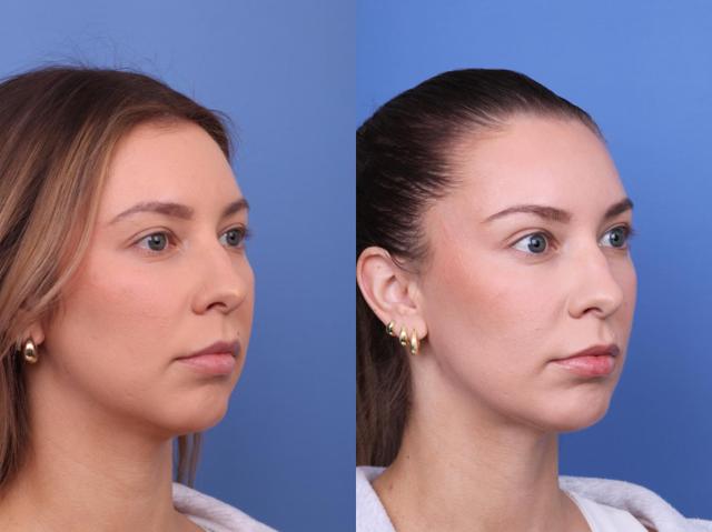Chin Implant result at Todd Hobgood, MD in Scottsdale, AZ