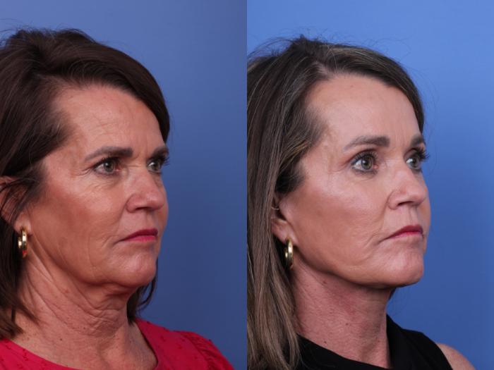 Todd Hobgood, MD brow lift result — Scottsdale, AZ