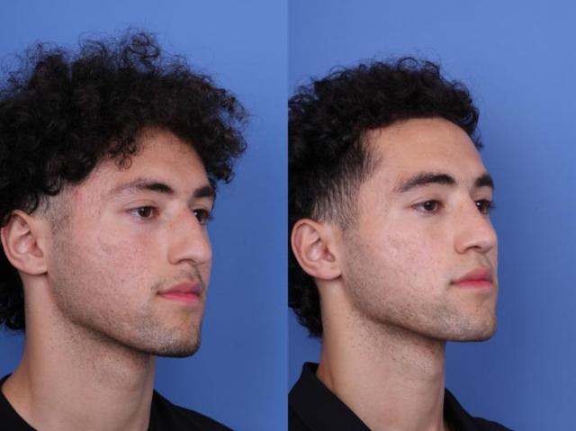 Rhinoplasty result at Todd Hobgood, MD in Scottsdale, AZ