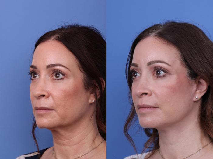 Todd Hobgood, MD facelift result — Scottsdale, AZ