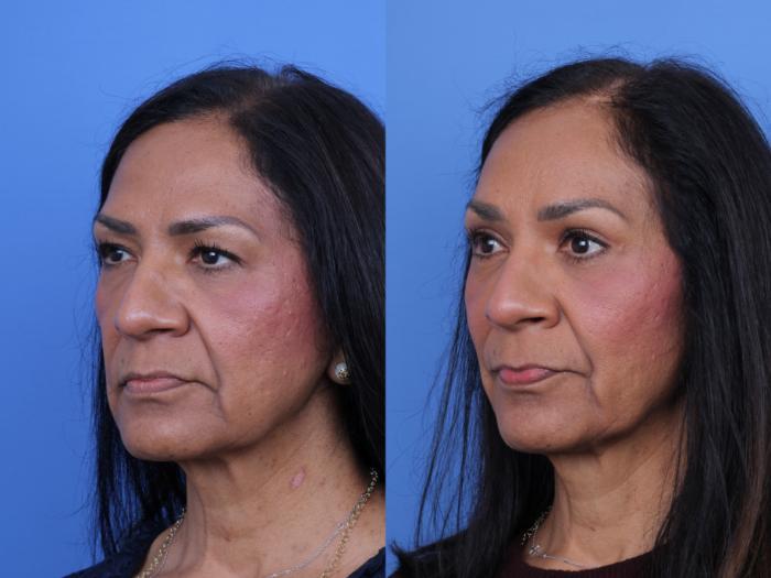 Todd Hobgood, MD brow lift result — Scottsdale, AZ