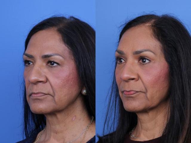 Brow Lift result at Todd Hobgood, MD in Scottsdale, AZ