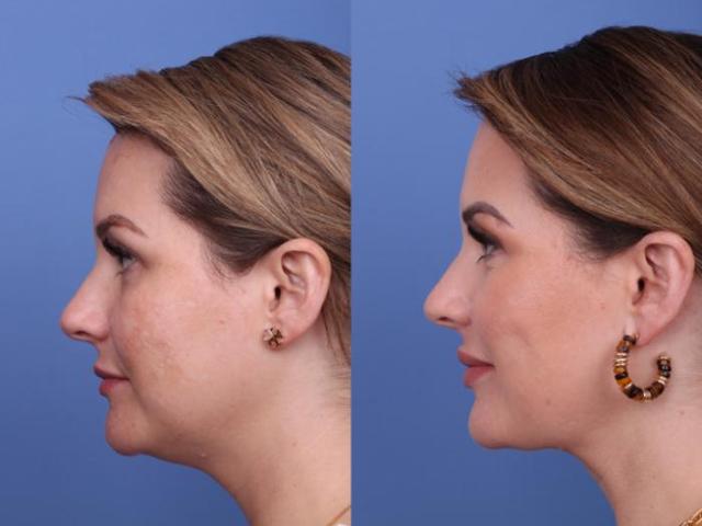 Liposuction result at Todd Hobgood, MD in Scottsdale, AZ