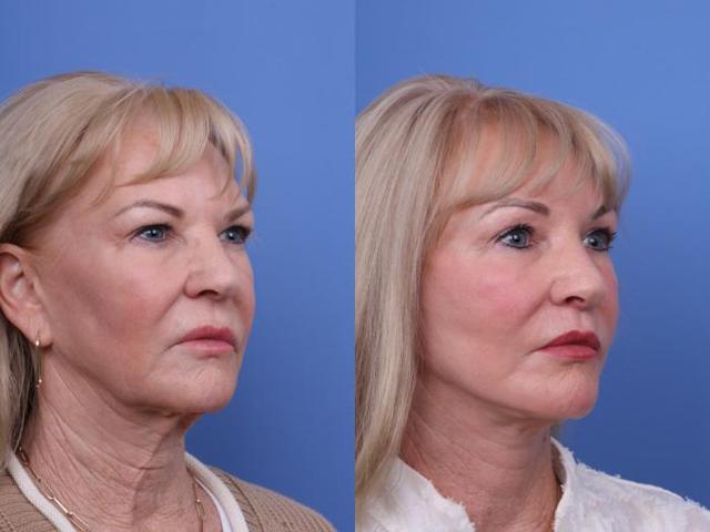 Chin Implant result at Todd Hobgood, MD in Scottsdale, AZ