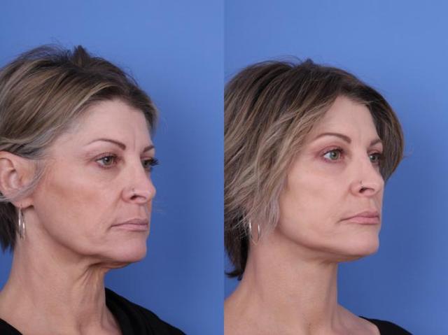 Blepharoplasty result at Todd Hobgood, MD in Scottsdale, AZ