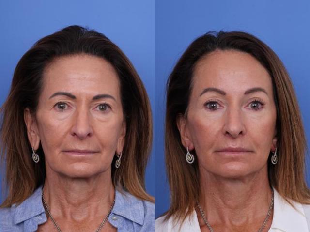 Chin Implant result at Todd Hobgood, MD in Scottsdale, AZ