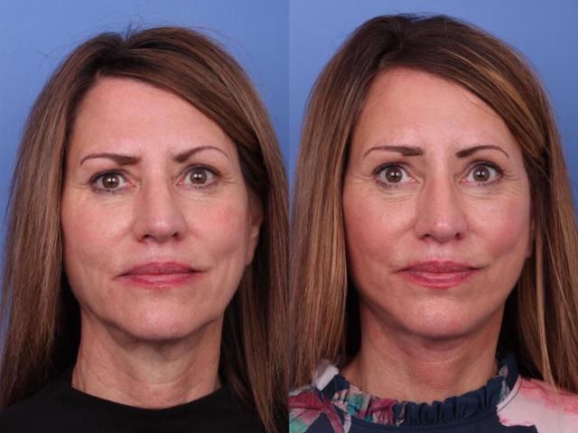 Brow Lift result at Todd Hobgood, MD in Scottsdale, AZ